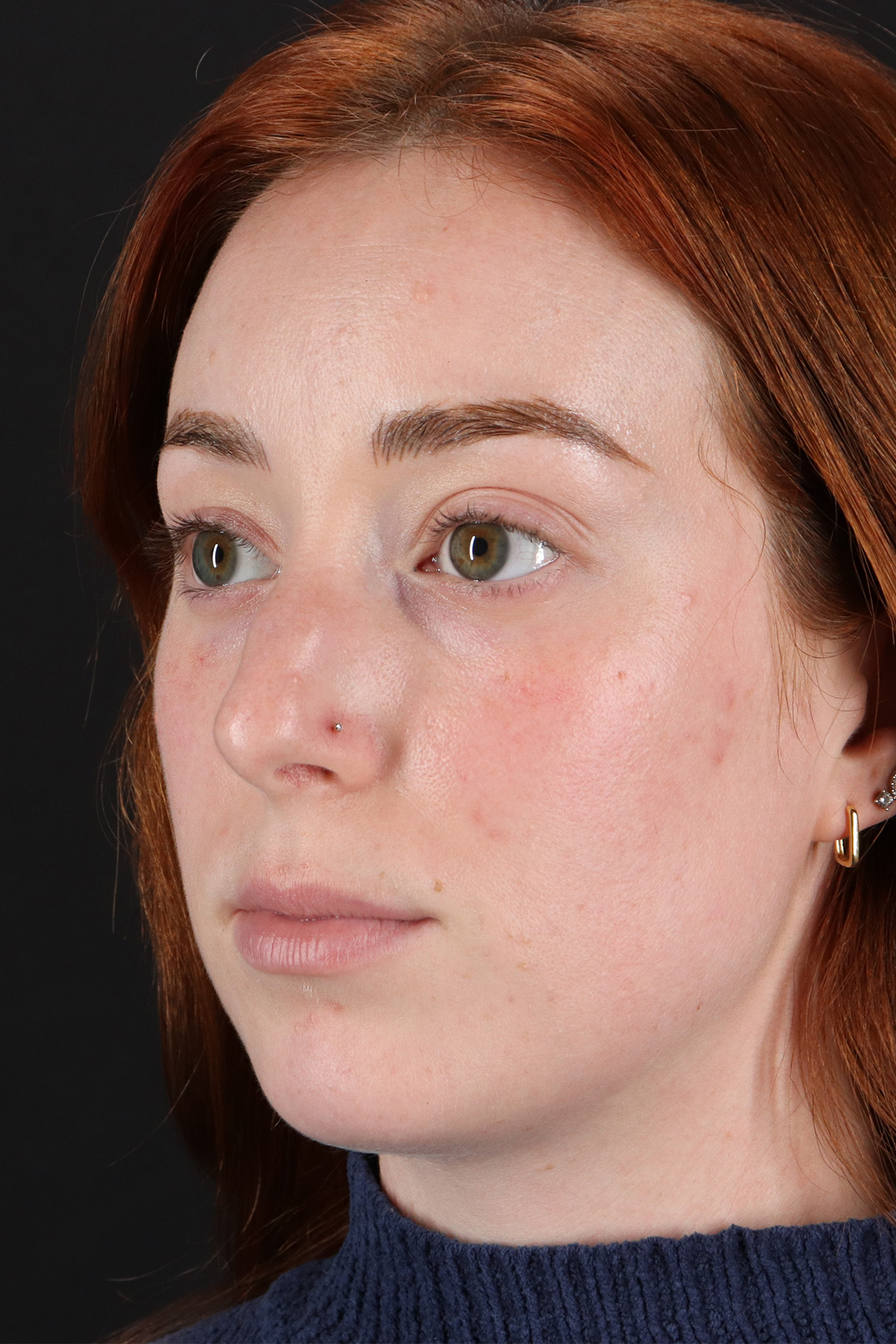 Rhinoplasty Before & After Patient #3170