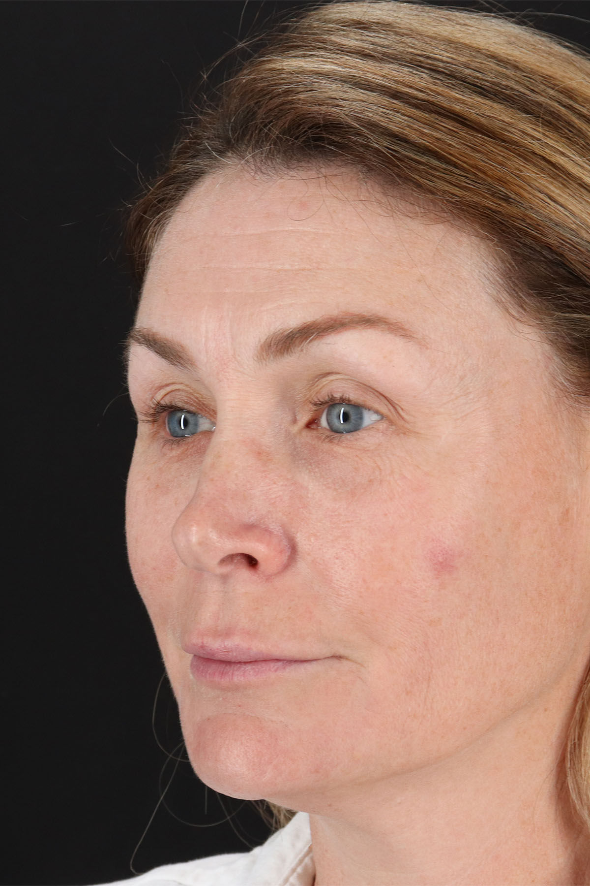 Lip Lift Before & After Patient #2144