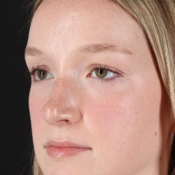 Liquid Rhinoplasty Before & After Patient #2177