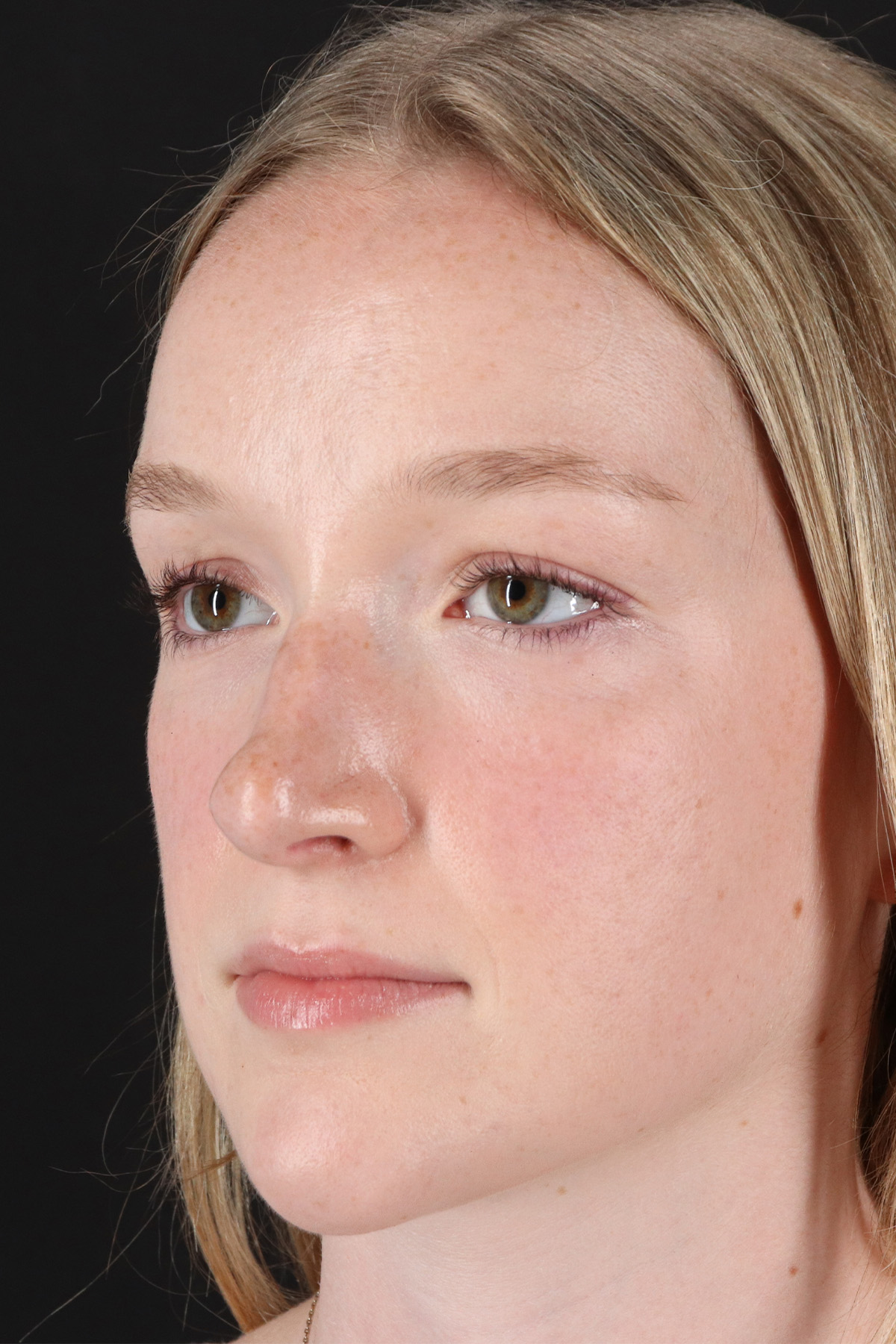 Liquid Rhinoplasty Before & After Patient #2177