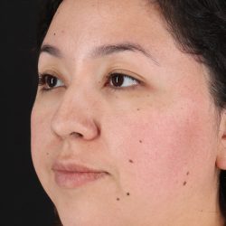 Rhinoplasty Before & After Patient #3060