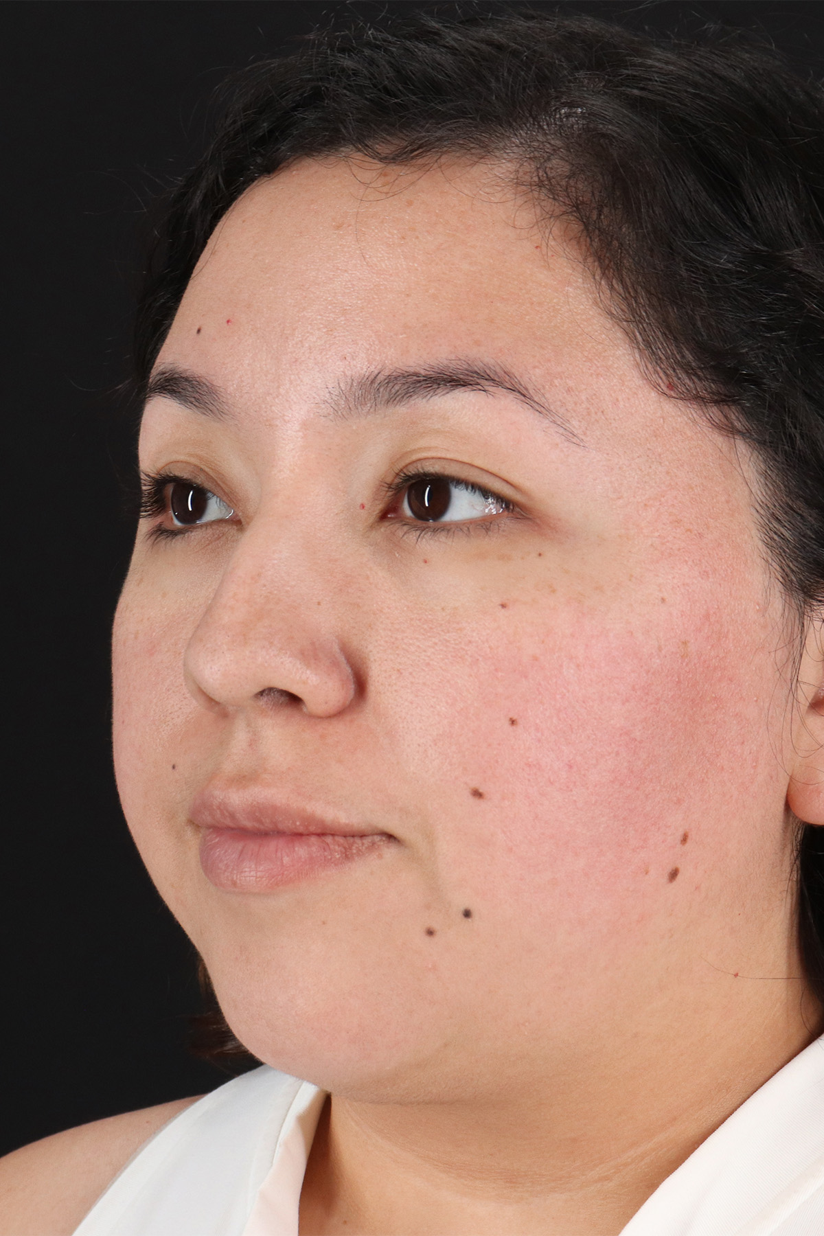 Rhinoplasty Before & After Patient #3060