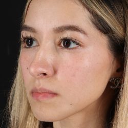 Rhinoplasty Before & After Patient #3302