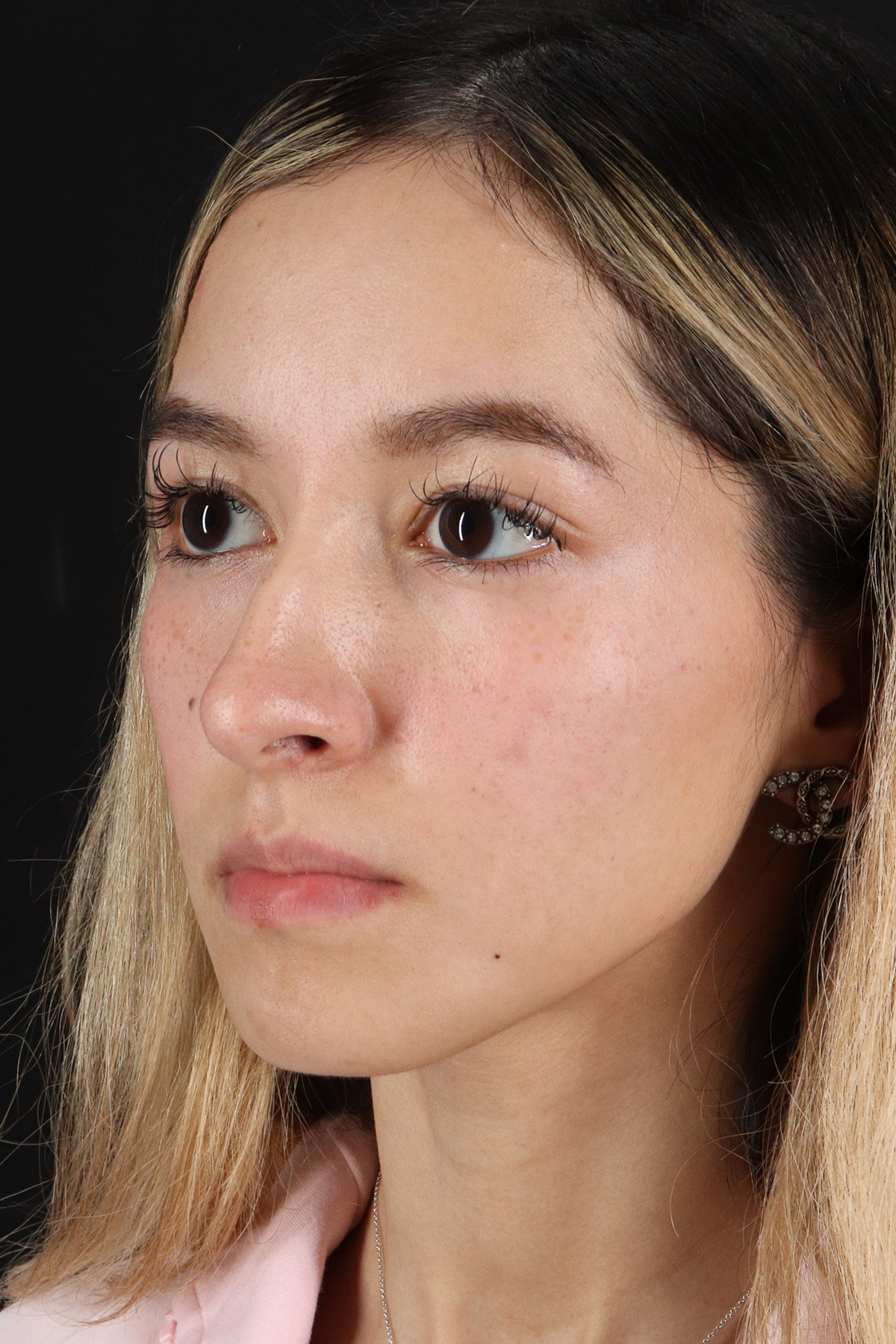 Rhinoplasty Before & After Patient #3302