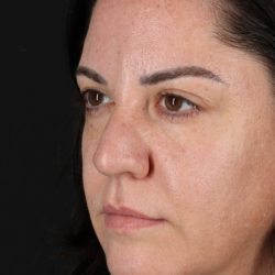 Browlift Before & After Patient #1363