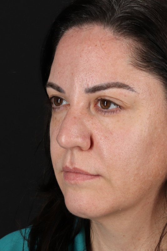 Browlift Before & After Patient #1363