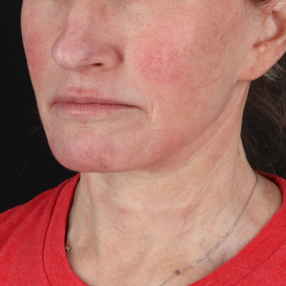 Neck Lift Before & After Patient #2571