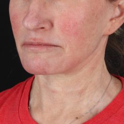 Facelift Before & After Patient #1866
