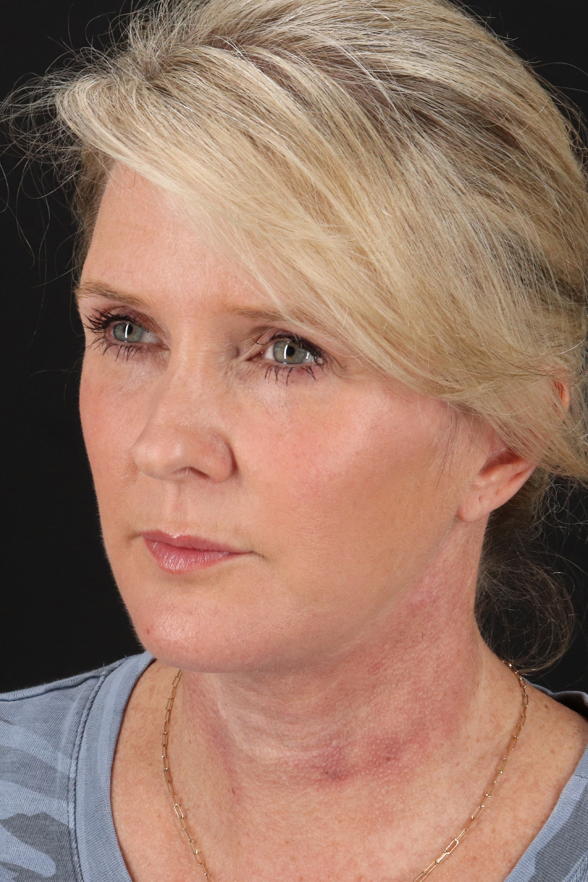Facelift Before & After Patient #1877