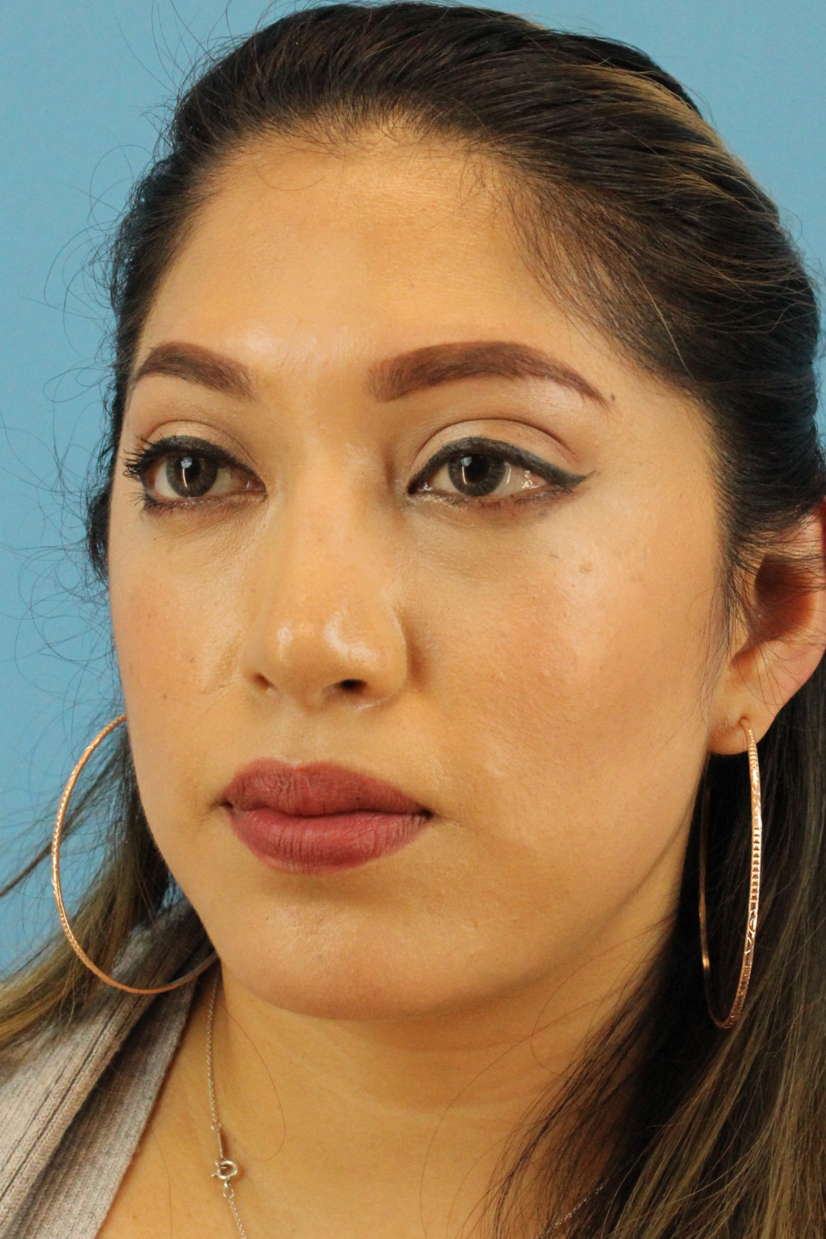 Chin Implant Before & After Patient #1670
