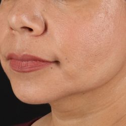 Facelift Before & After Patient #3555