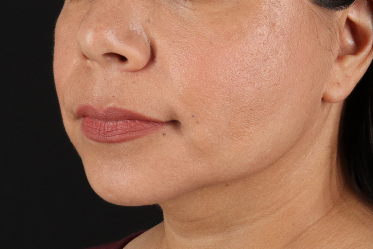 Facelift Before & After Patient #3555