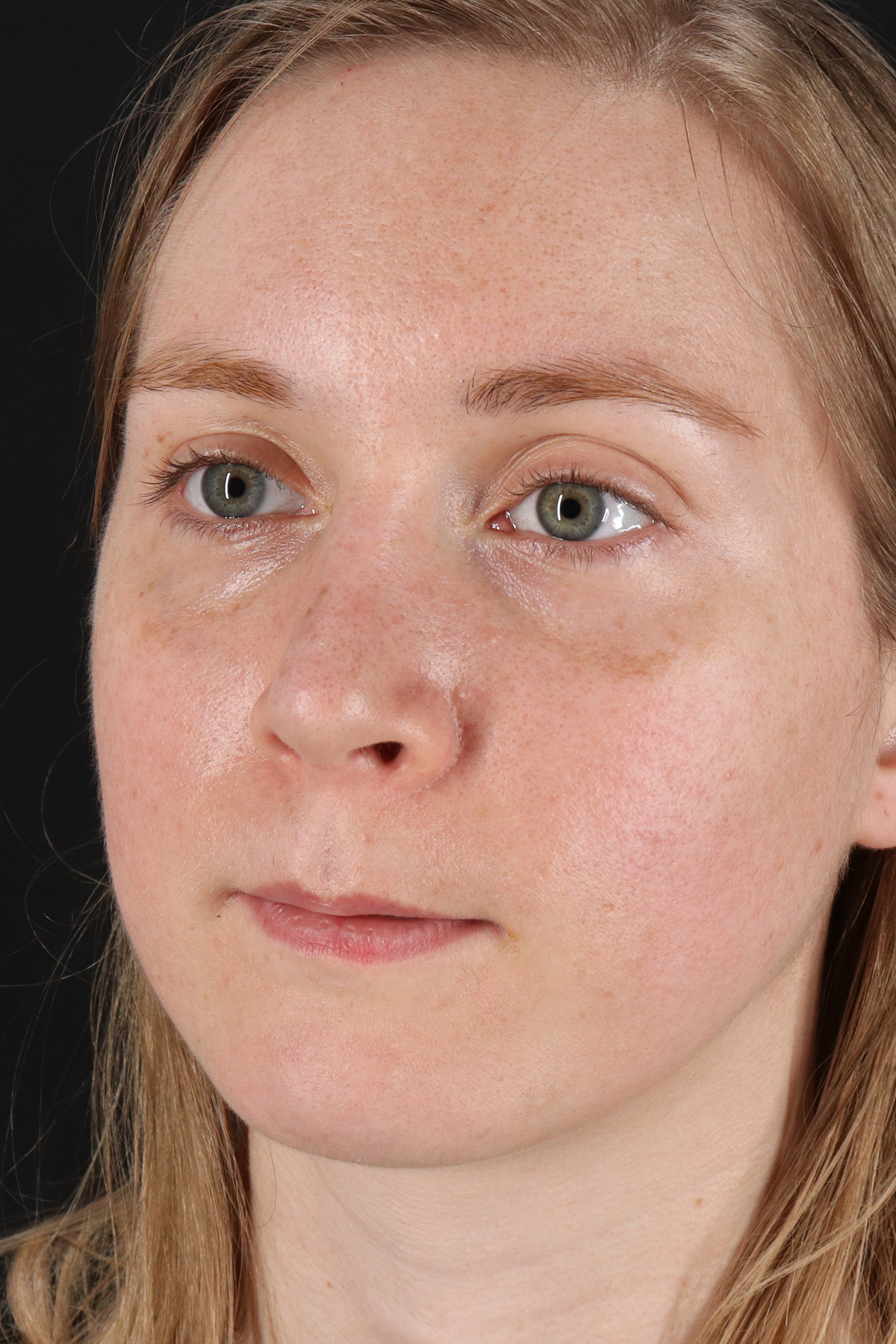 Rhinoplasty Before & After Patient #3280