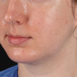 Chin Implant Before & After Patient #1562