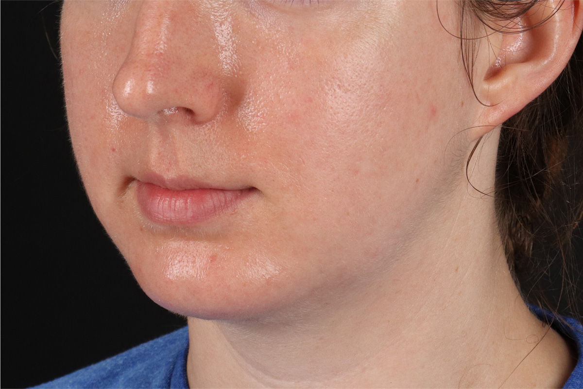 Chin Implant Before & After Patient #1562
