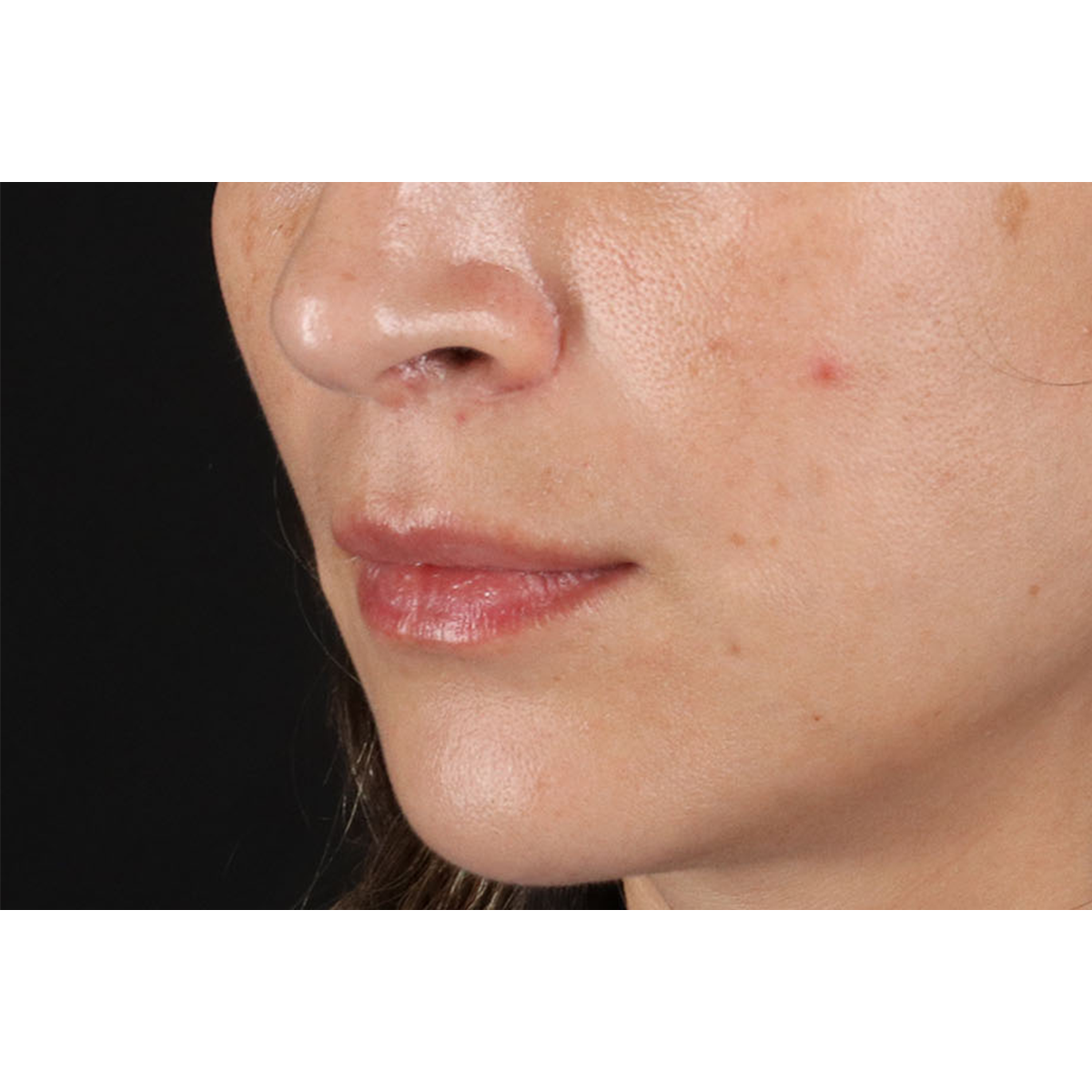 Lip Lift Before & After Patient #2166