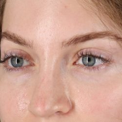 Browlift Before & After Patient #1319