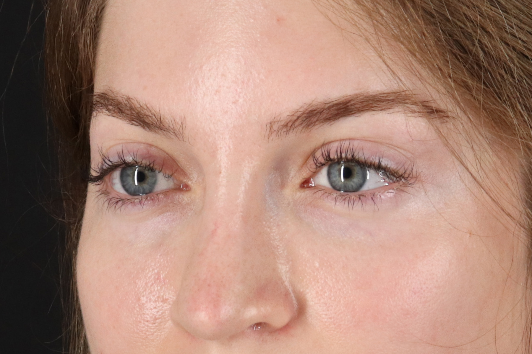 Browlift Before & After Patient #1319