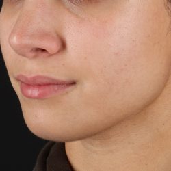 Chin Implant Before & After Patient #1573