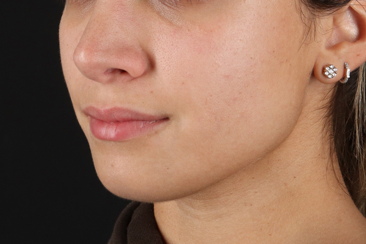 Chin Implant Before & After Patient #1573