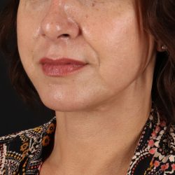 Facelift Before & After Patient #1809