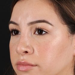 Rhinoplasty Before & After Patient #3247
