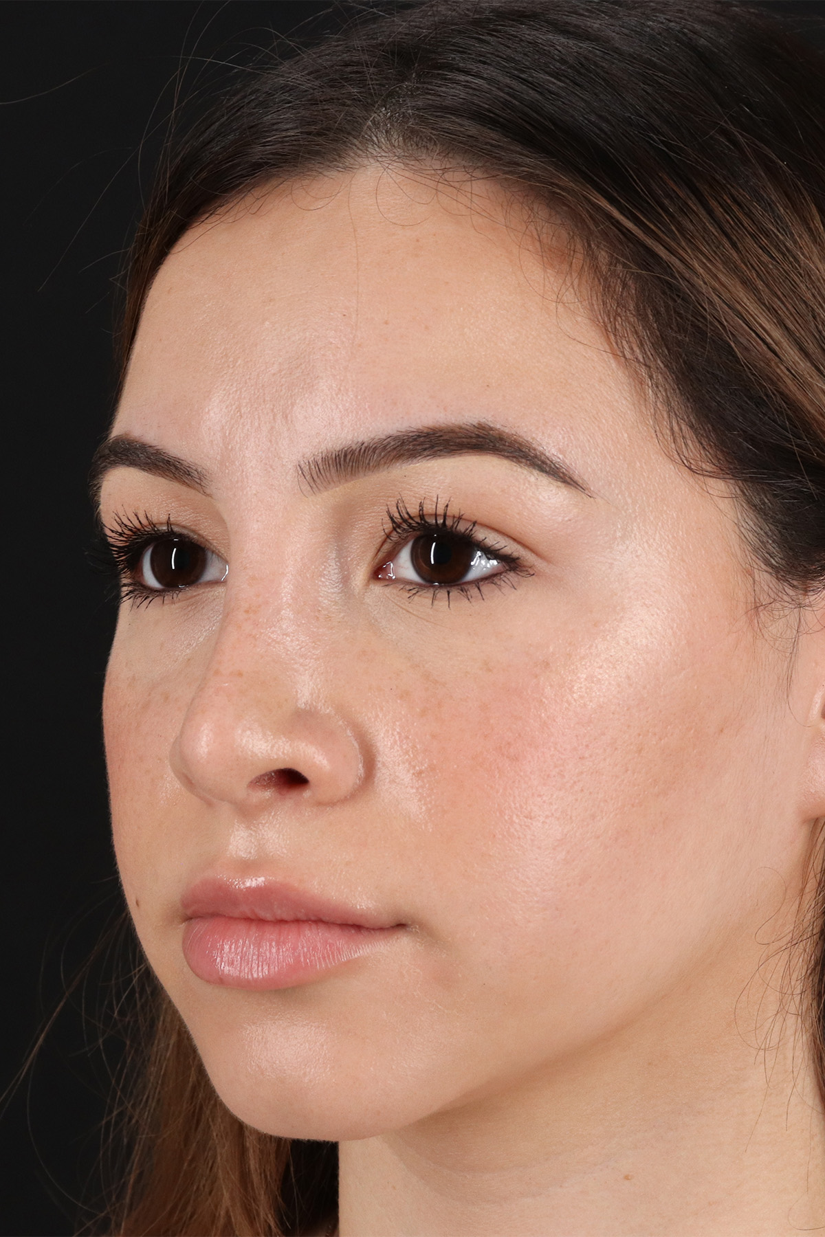 Rhinoplasty Before & After Patient #3247
