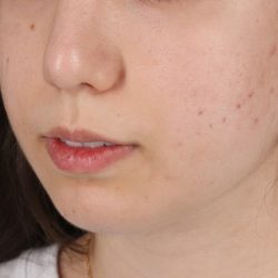 Chin Implant Before & After Patient #1551