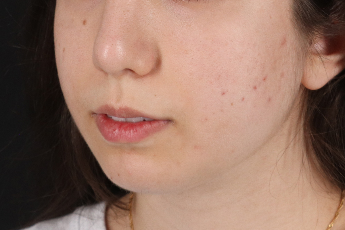 Chin Implant Before & After Patient #1551