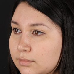 Chin Implant Before & After Patient #1604