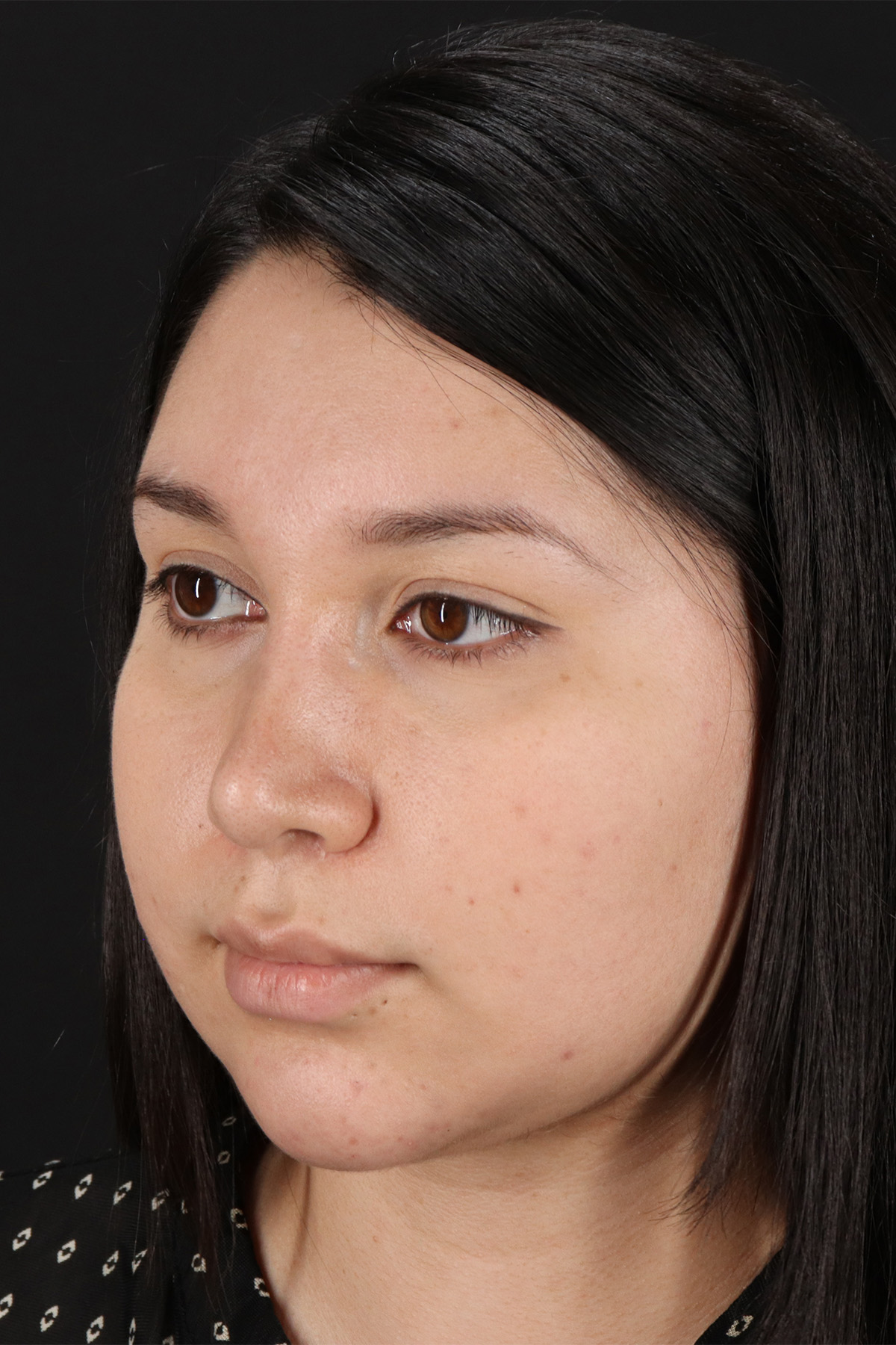Chin Implant Before & After Patient #1604