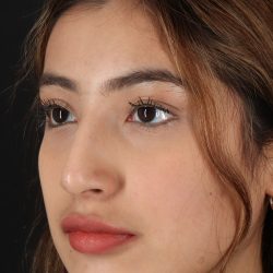 Liquid Rhinoplasty Before & After Patient #2254