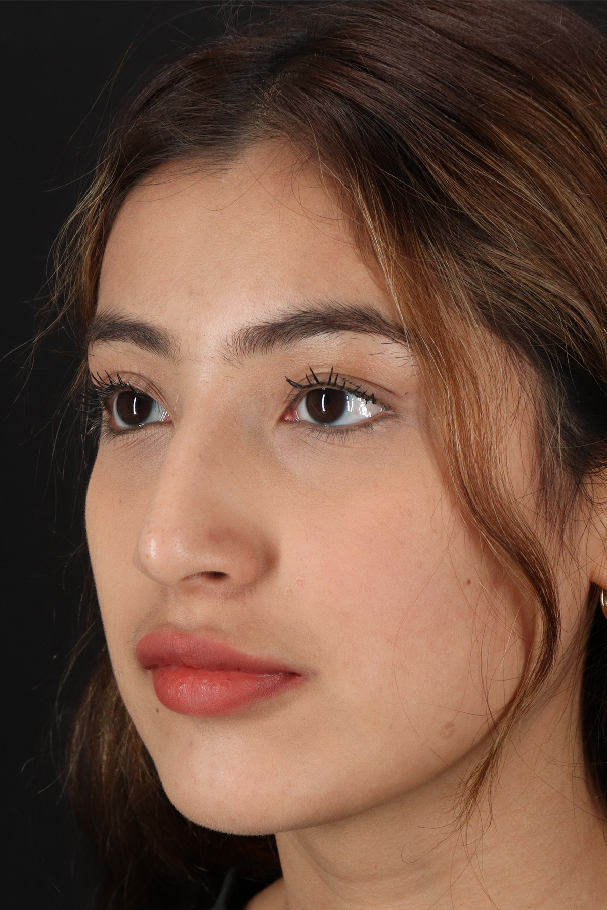 Liquid Rhinoplasty Before & After Patient #2254