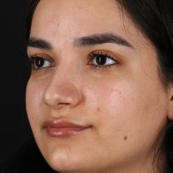Rhinoplasty Before & After Patient #3071