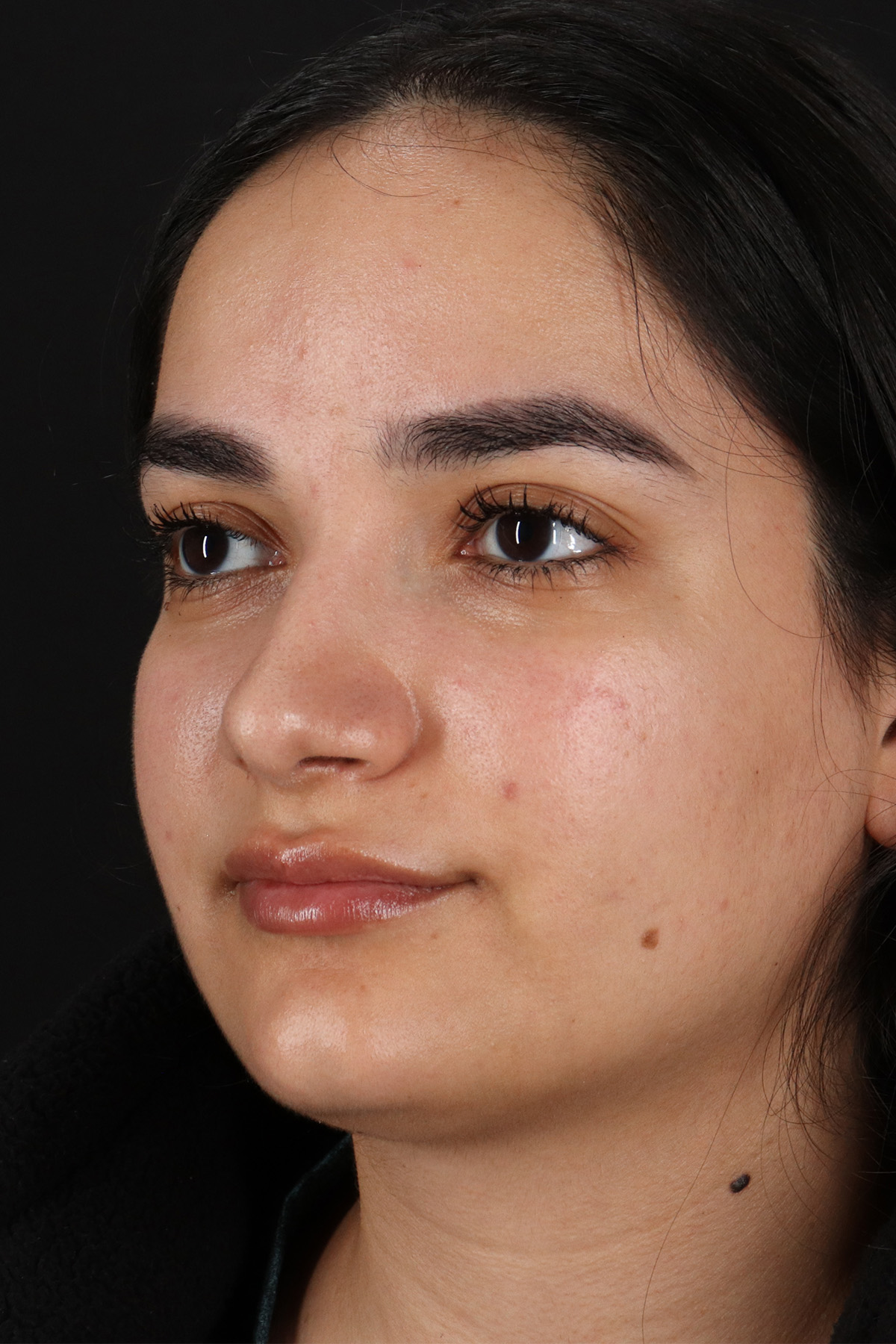 Rhinoplasty Before & After Patient #3071