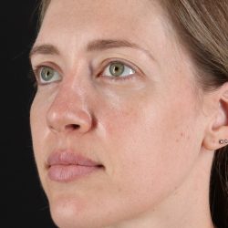 Rhinoplasty Before & After Patient #3291