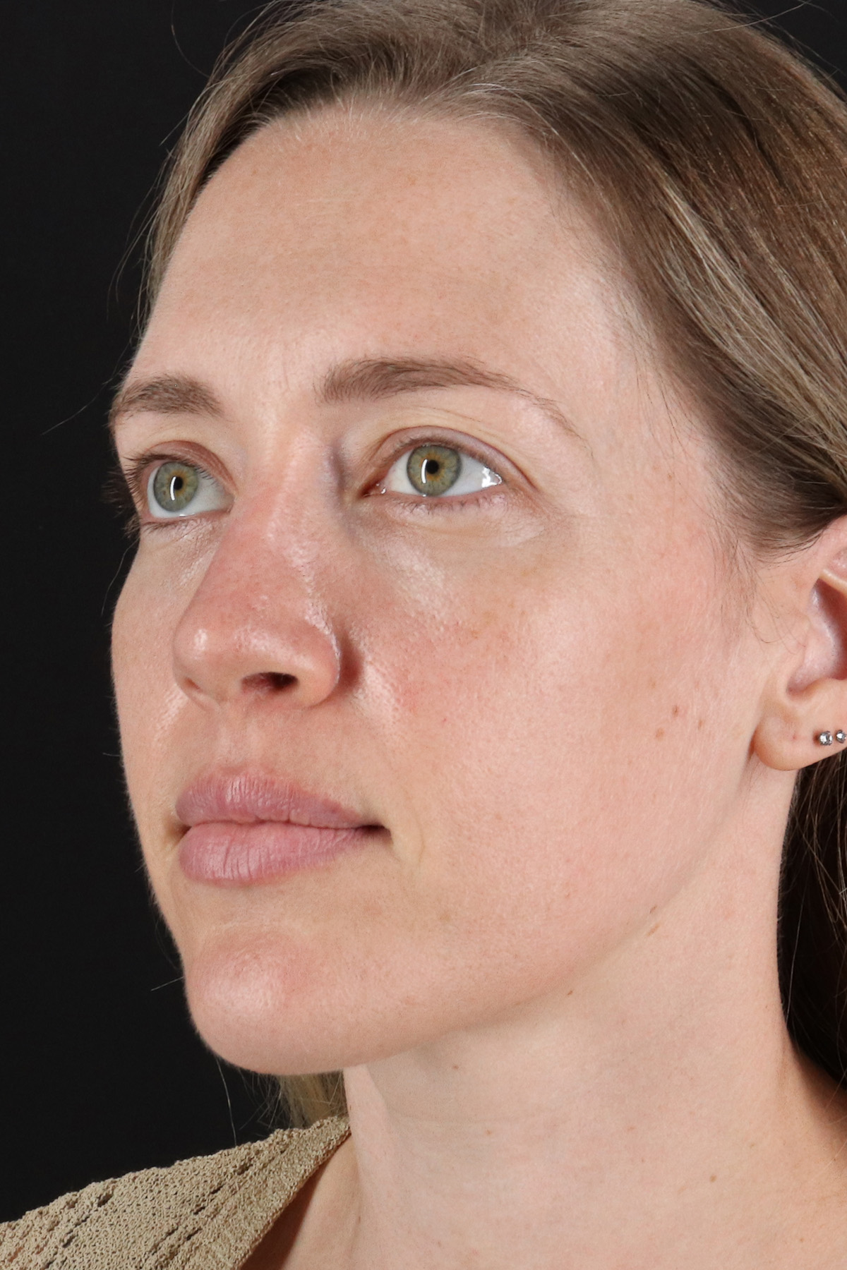 Rhinoplasty Before & After Patient #3291
