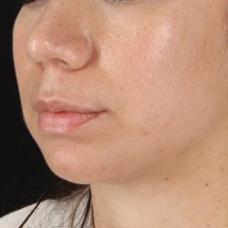 Chin Implant Before & After Patient #1540