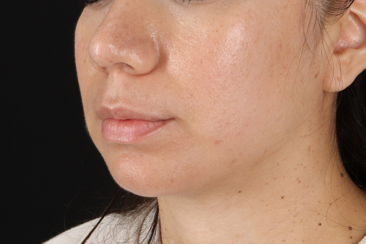 Chin Implant Before & After Patient #1540