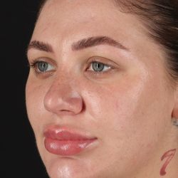 Rhinoplasty Before & After Patient #3104