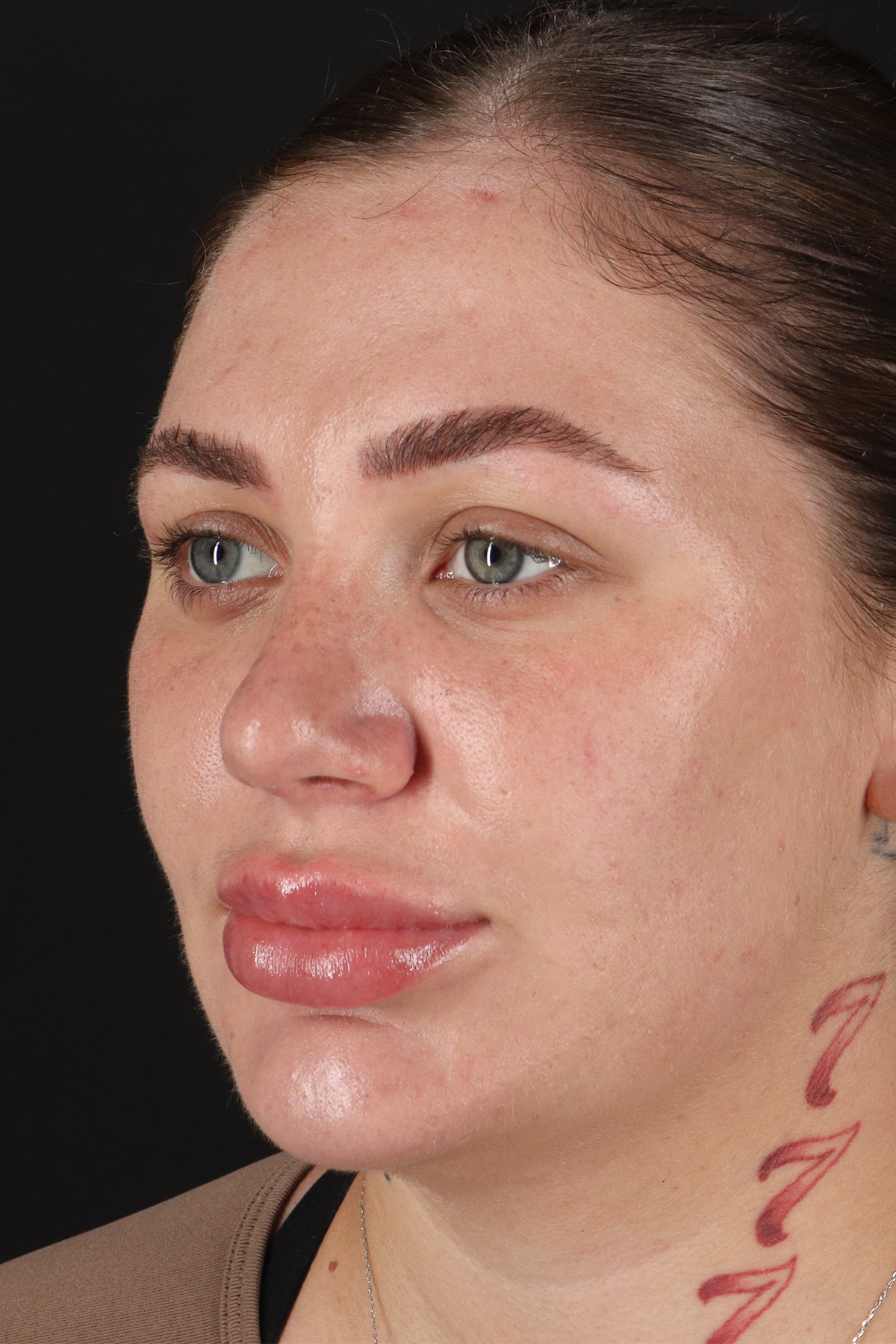 Rhinoplasty Before & After Patient #3104