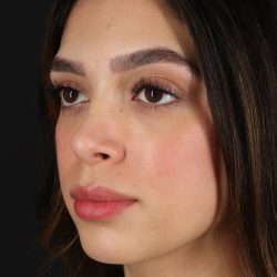 Rhinoplasty Before & After Patient #3269