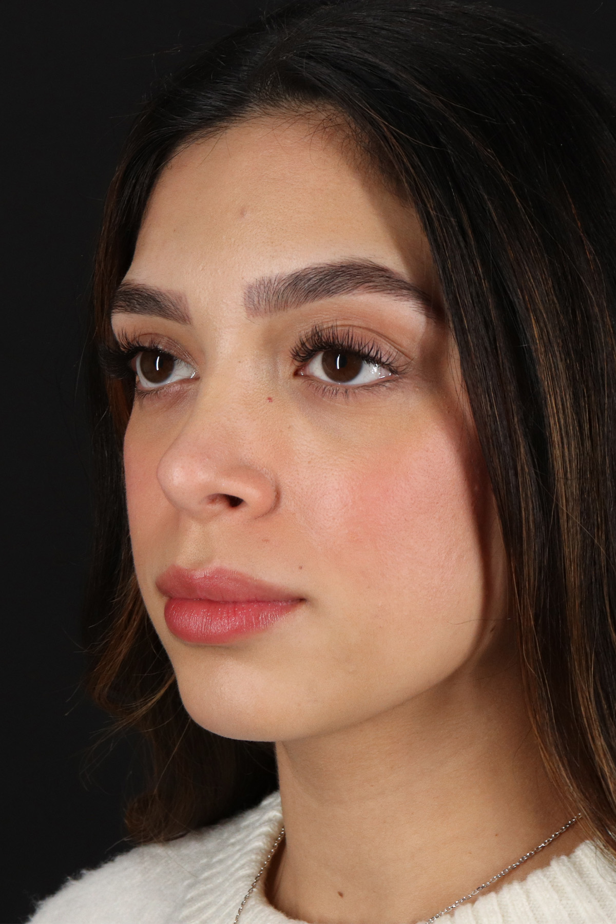 Rhinoplasty Before & After Patient #3269
