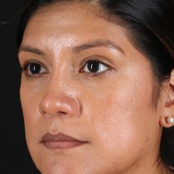 Rhinoplasty Before & After Patient #3181