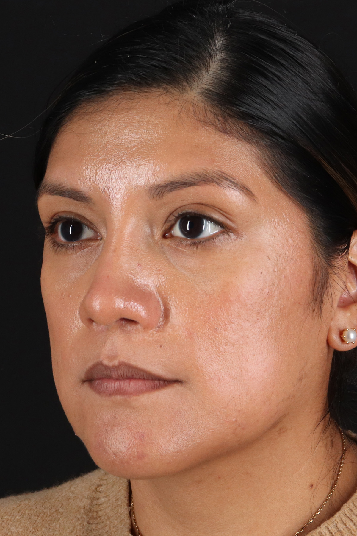 Rhinoplasty Before & After Patient #3181