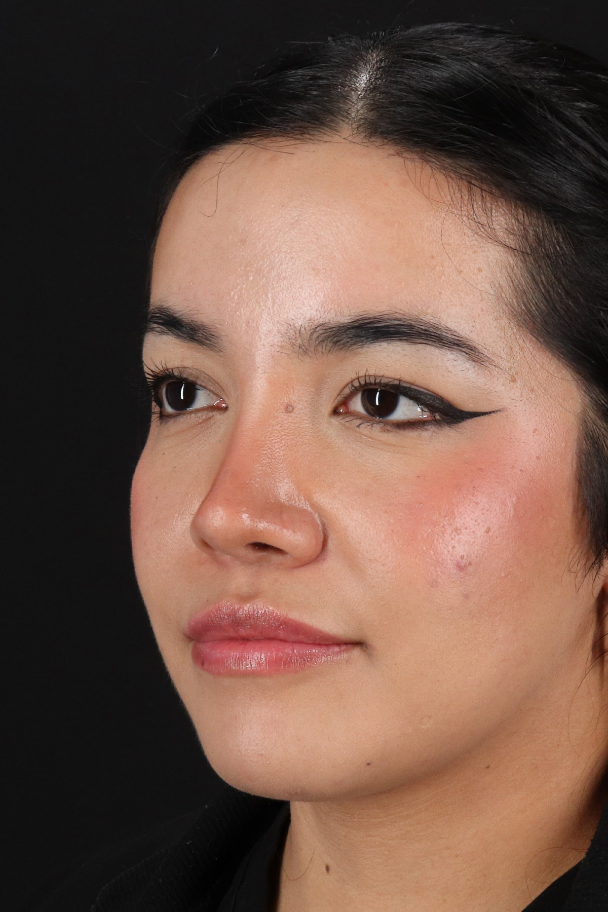 Liquid Rhinoplasty Before & After Patient #2265