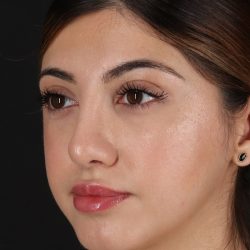 Rhinoplasty Before & After Patient #3214