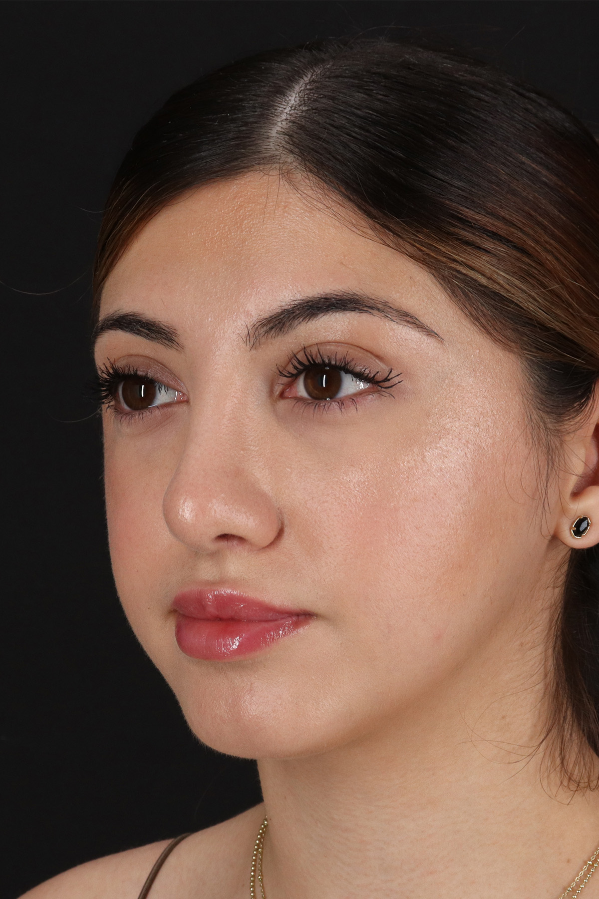Rhinoplasty Before & After Patient #3214
