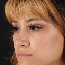 Rhinoplasty Before & After Patient #3038
