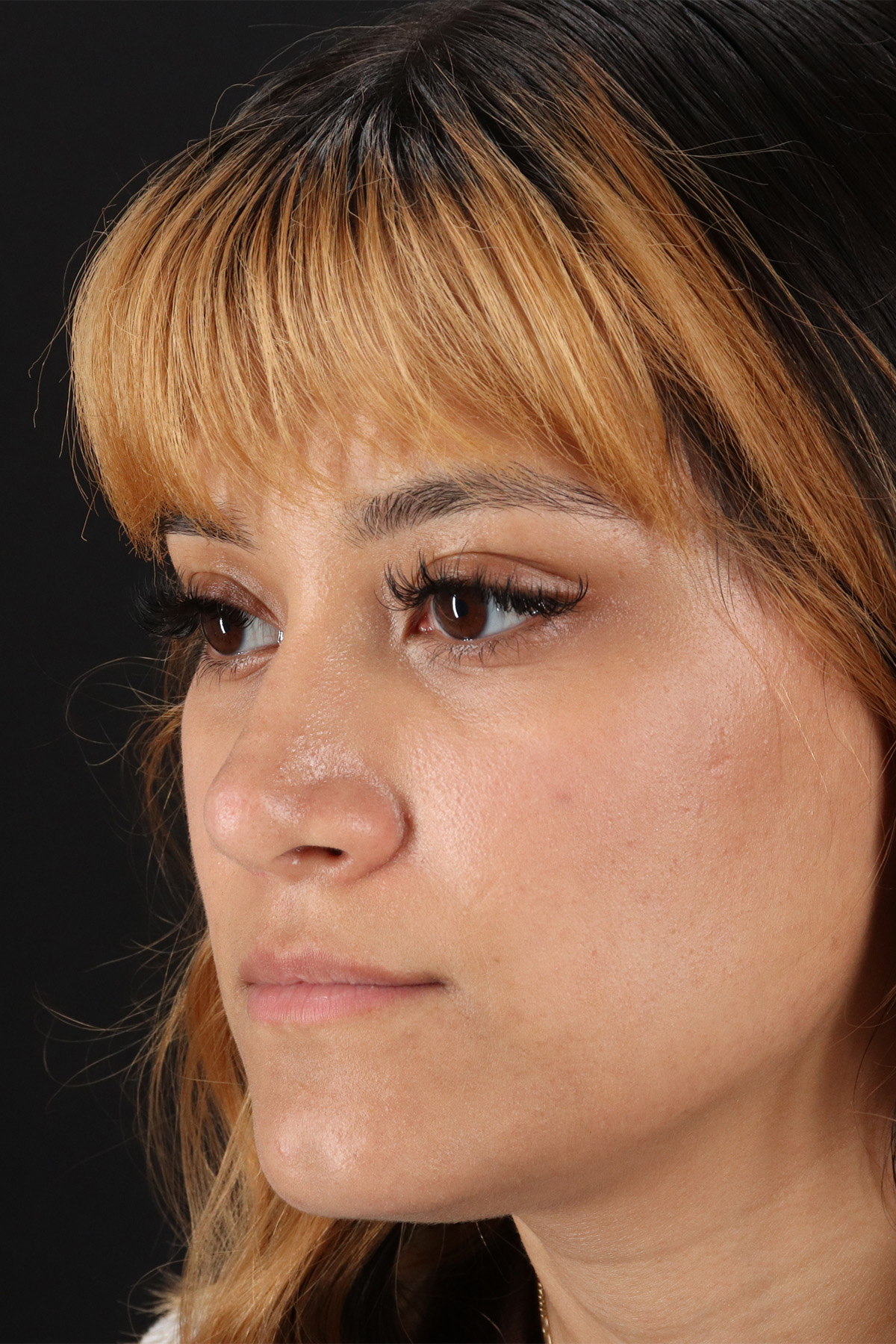 Rhinoplasty Before & After Patient #3038